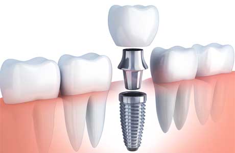Implant dentaire à Chambéry