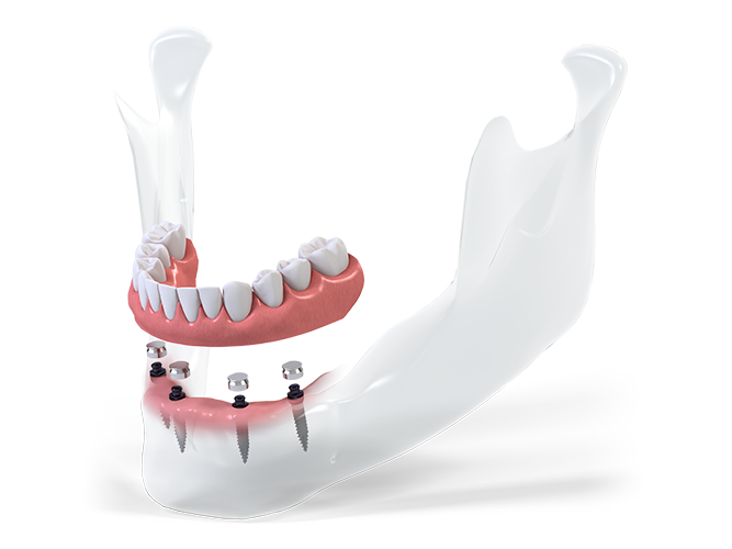 Prothèse Dentaire Amovible : Remplacer par un Implant
